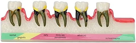 מודל למחלות שיניים, פתולוגיה שיניים מודל חינוכי מוצק לאוניברסיטאות שיניים