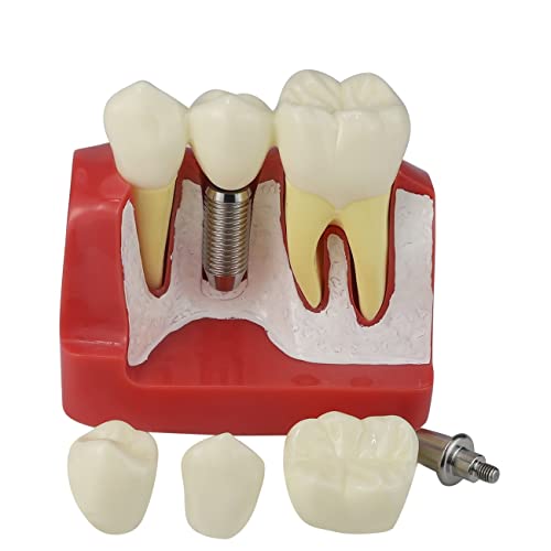 טפטוארך 4 פעמים שיניים הוראת שתל ניתוח כתר גשר הכתר מודל נשלף הדגמת שיניים מודל שיניים