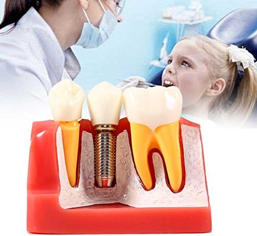 מודל שיניים מטופח, שרף שיניים הפגנת חינוך מודל שיניים ניתוח השתל גשר כתר לבית הספר לרופאי שיניים, פוסטר/מודל