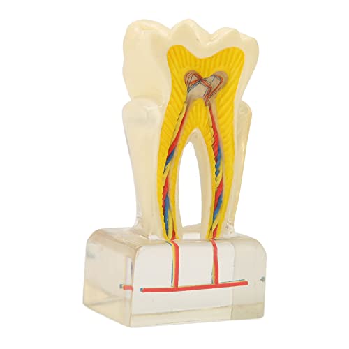 שיניים עששת דגם, אקריליק 6 פעמים רקובים שן דגם שיניים חינוך אספקת שיניים דגם עששת שיניים דגם עבור רופאי